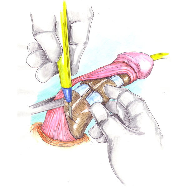 Prótesis de pene inflable