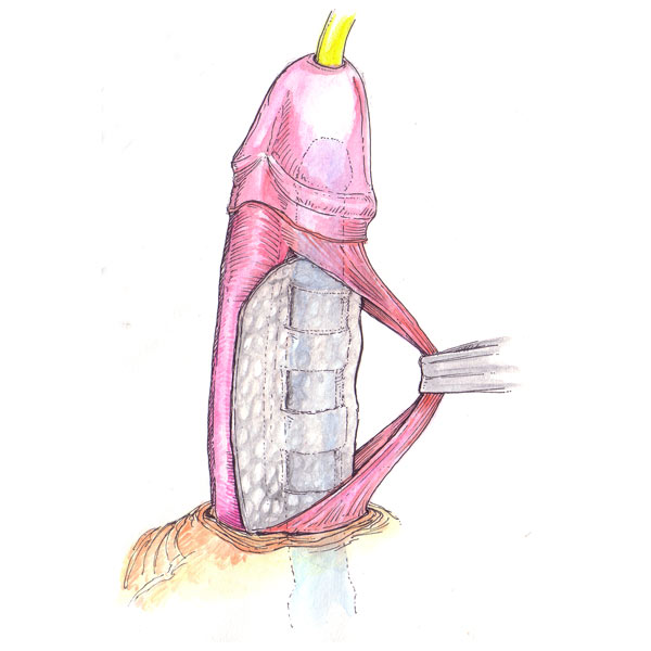 Prótesis de pene inflable